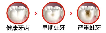 補(bǔ)一個(gè)牙洞要多少錢