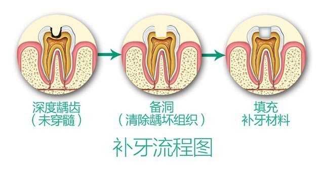 成人補(bǔ)烤瓷牙需要多長(zhǎng)時(shí)間